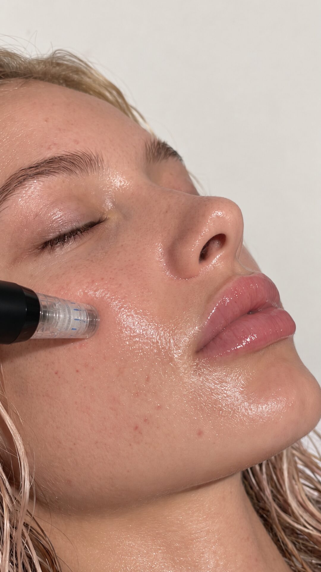 Microneedling treatment