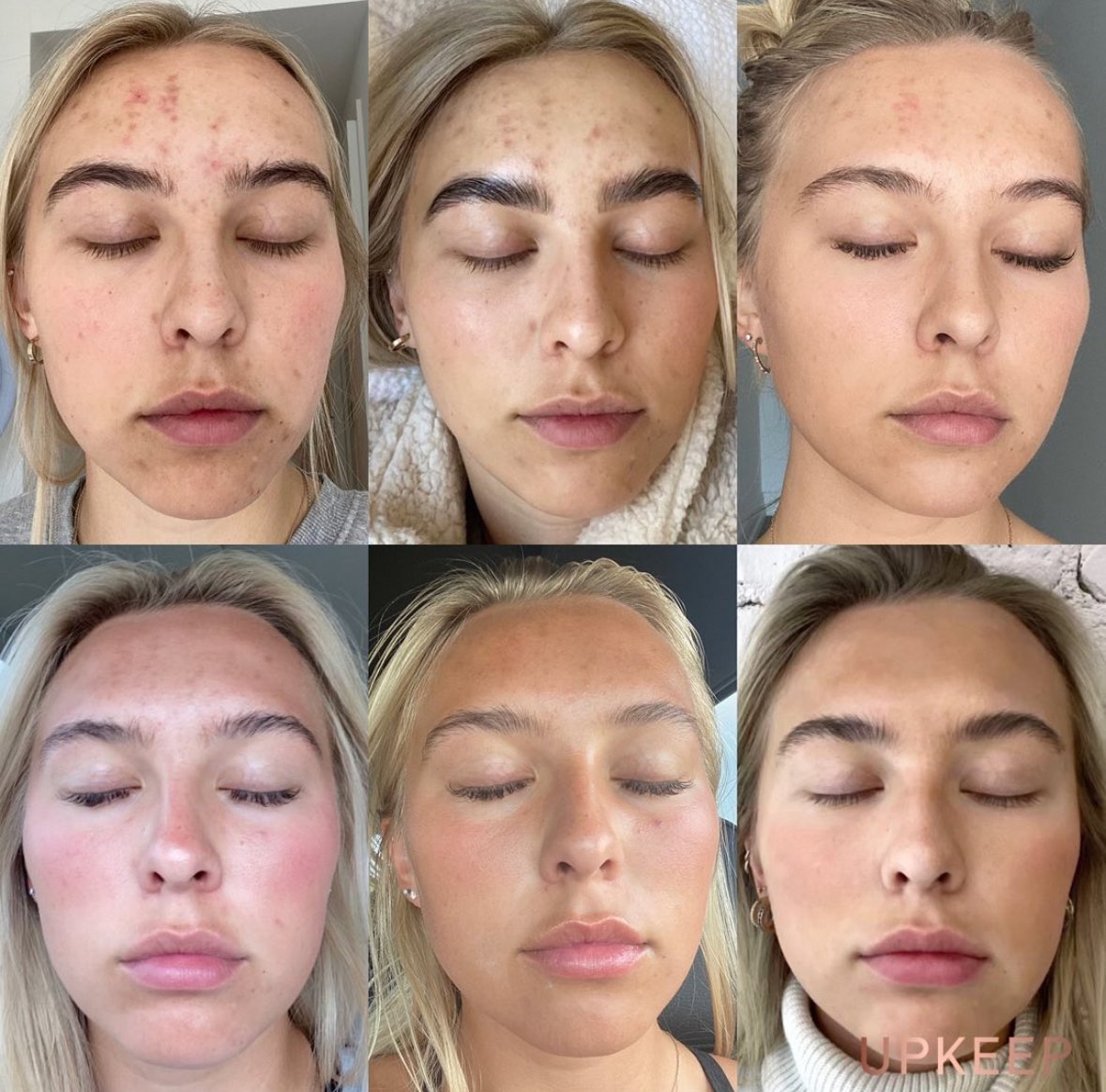 Radio frequency microneedling before and after — improved texture and firmness