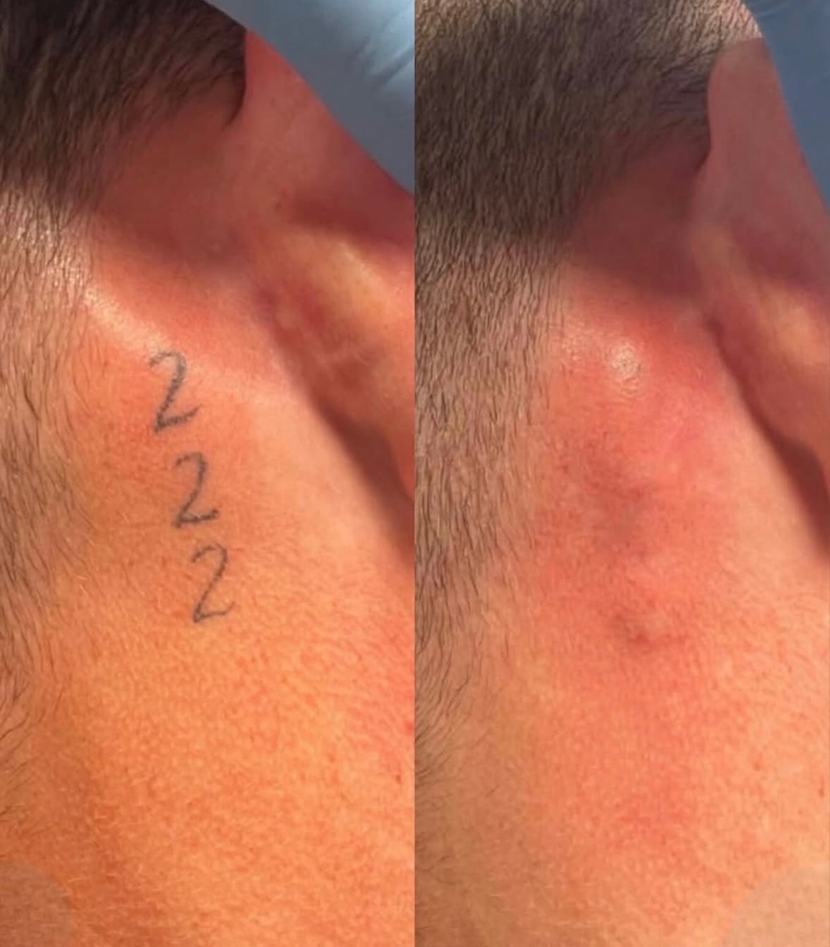 Laser tattoo removal before and after — faded ink