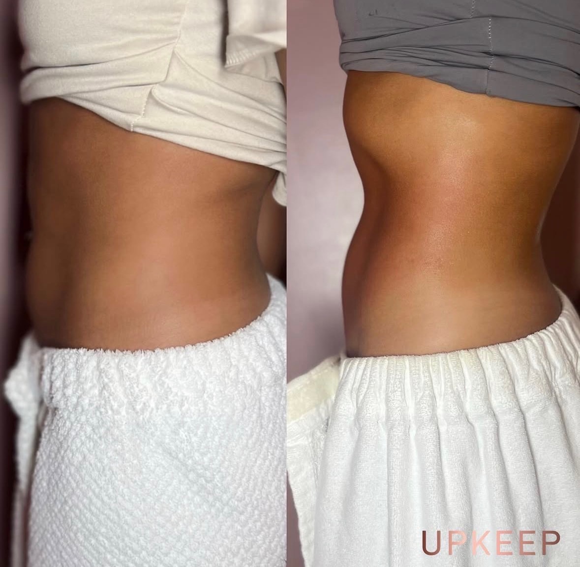 Venus Freeze on stomach before and after — smoother appearance