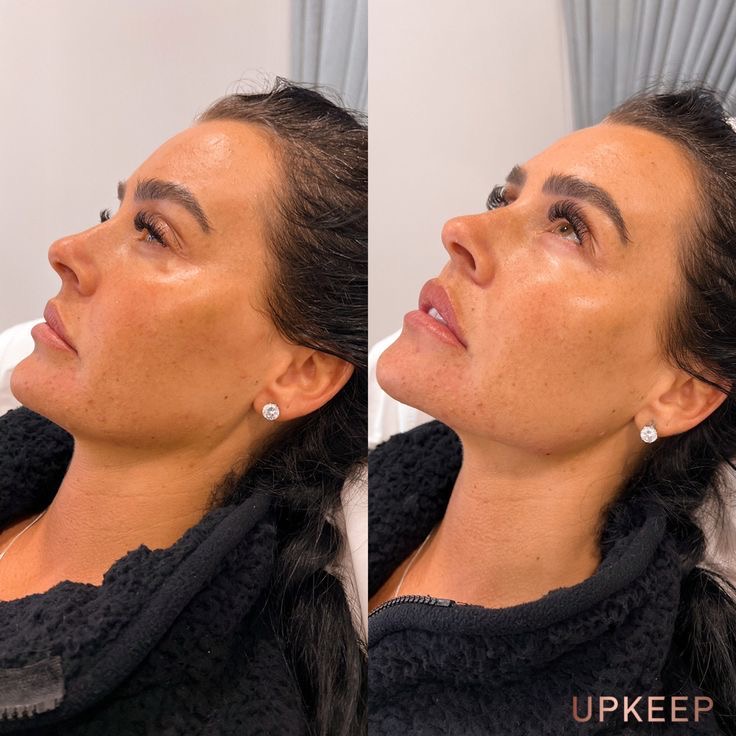 Facial balancing before and after — cheeks and jawline enhancement