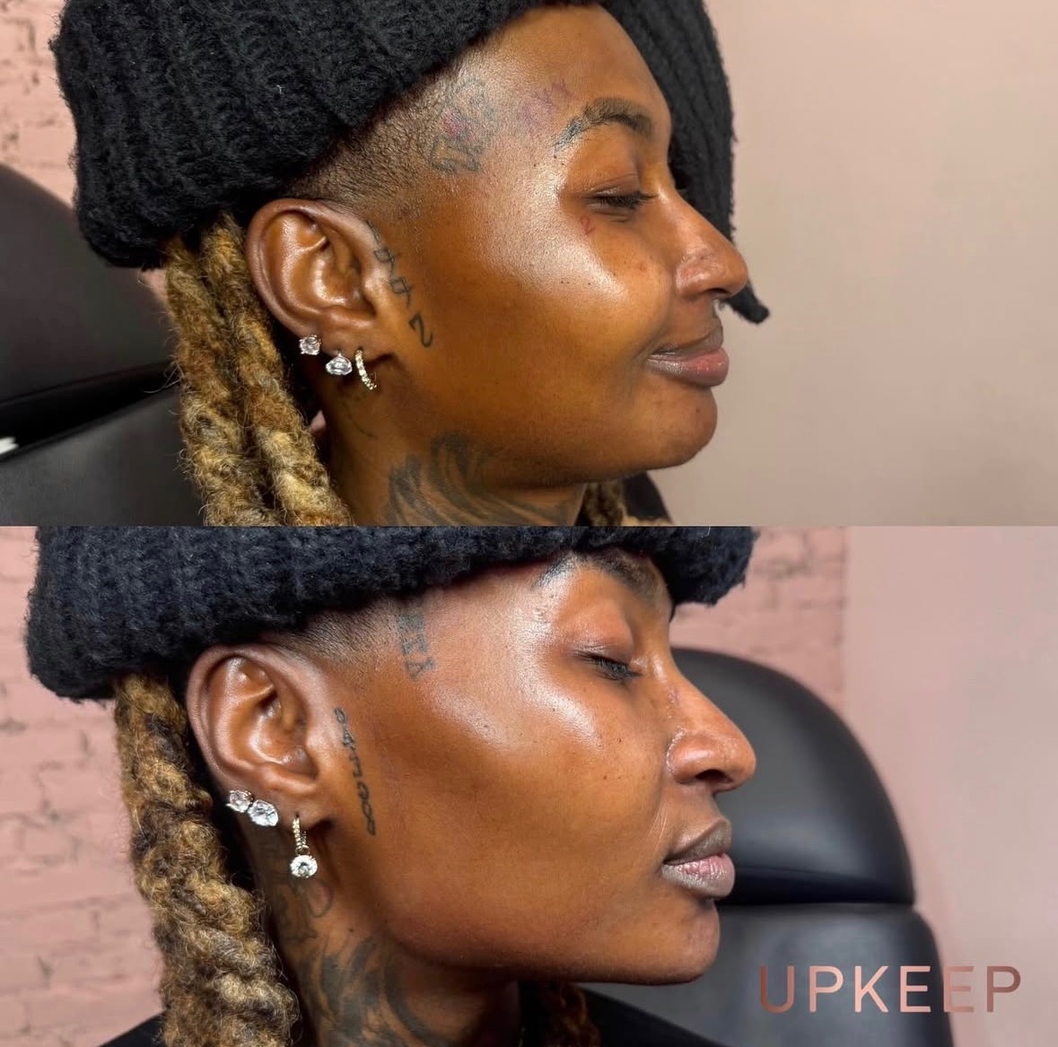 Facial balancing before and after — cheeks, chin, and jawline