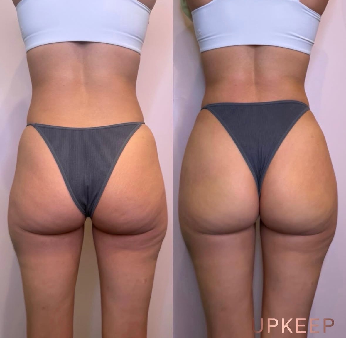 Radiesse BBL before and after — sculpted curves