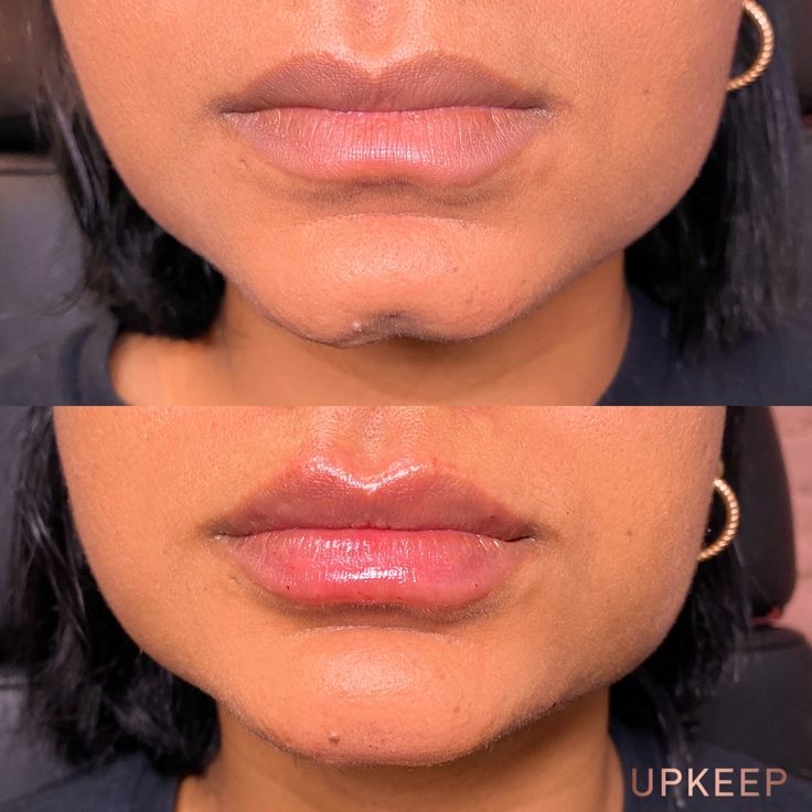 Chin enhancement before and after — refined proportions