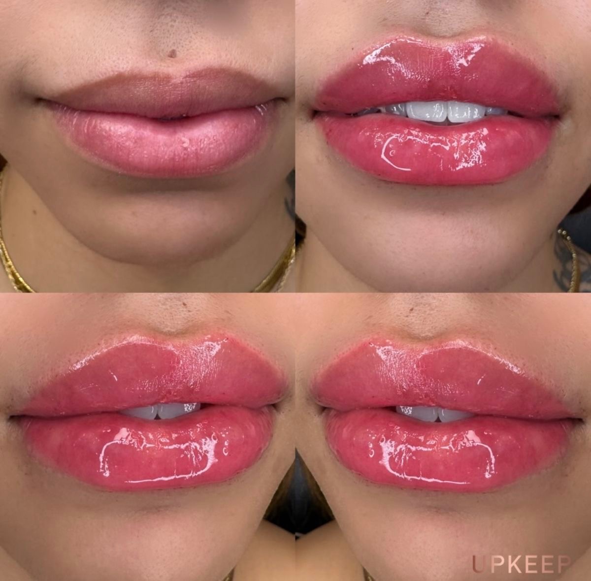 Full lip enhancement before and after — 1ml hyaluronic acid filler