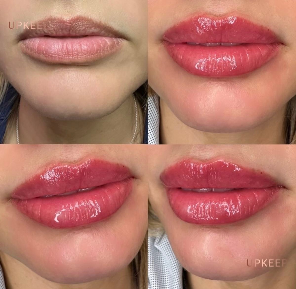 Full lip enhancement before and after — natural-looking volume