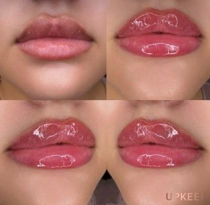 Full lip enhancement before and after