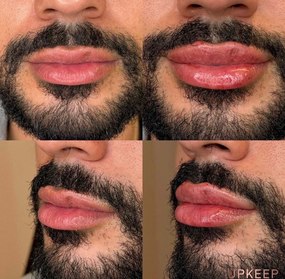 Quick lip enhancement before and after — male patient