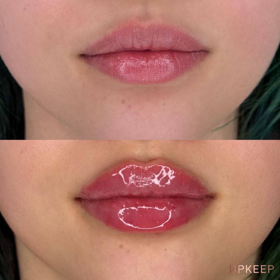Full lip enhancement before and after — subtle, balanced results