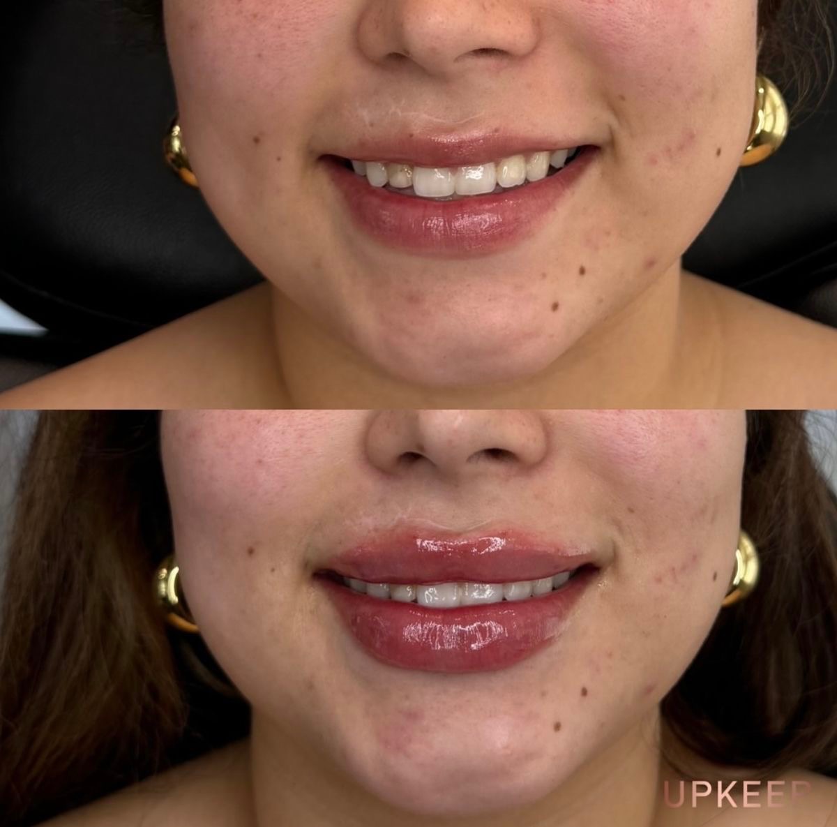 Full lip enhancement before and after