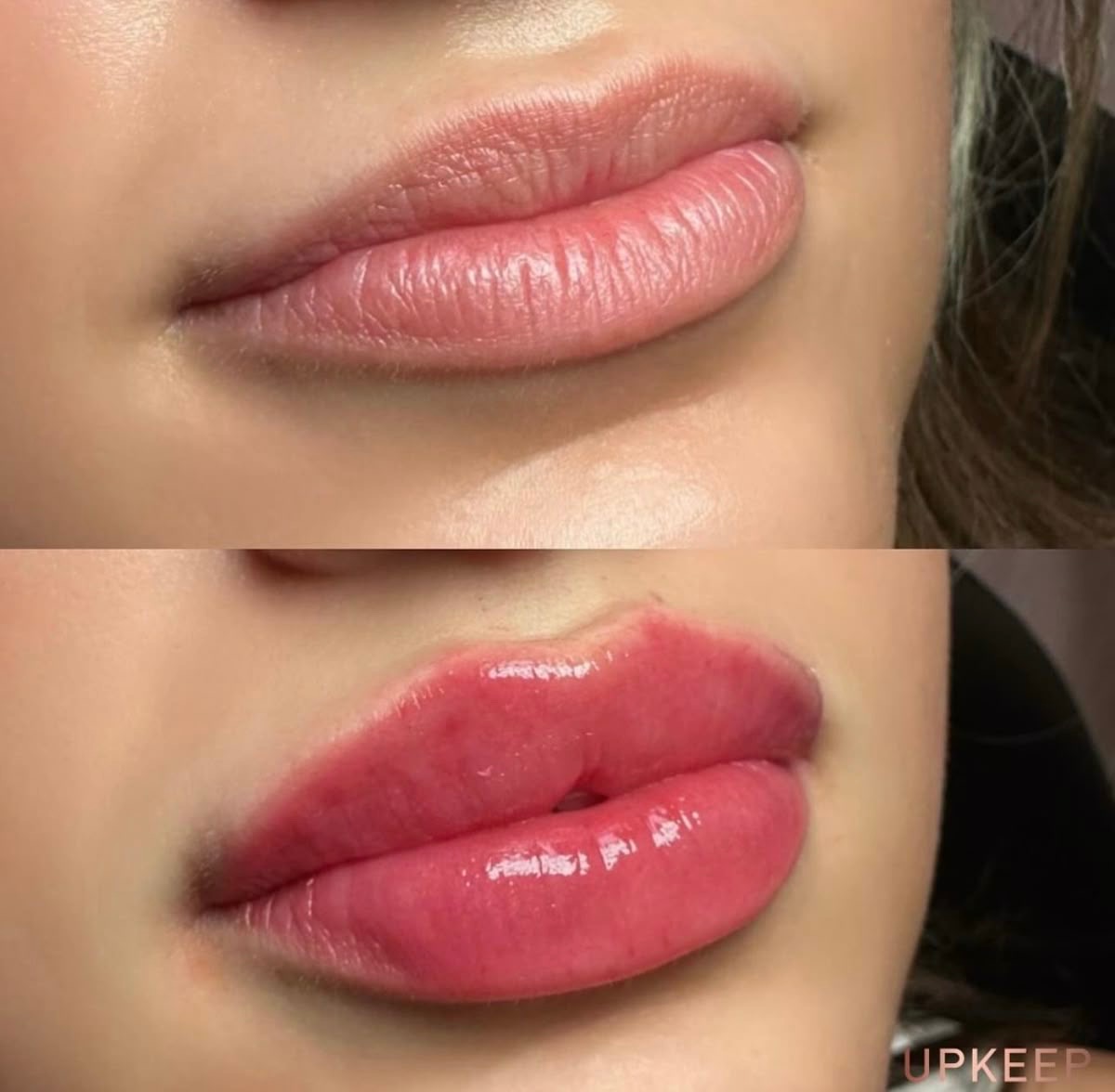 Full lip enhancement before and after — balanced, plump results
