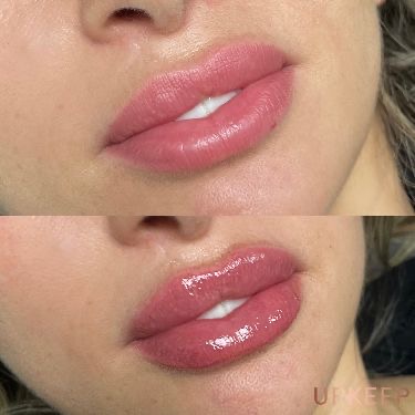 Quick lip enhancement before and after — natural results