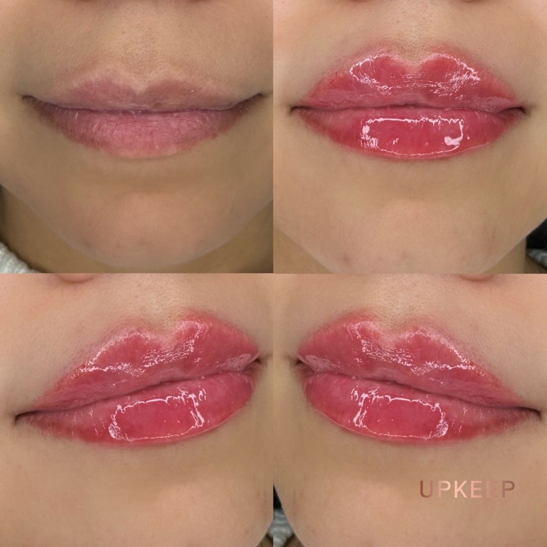 Full lip enhancement before and after