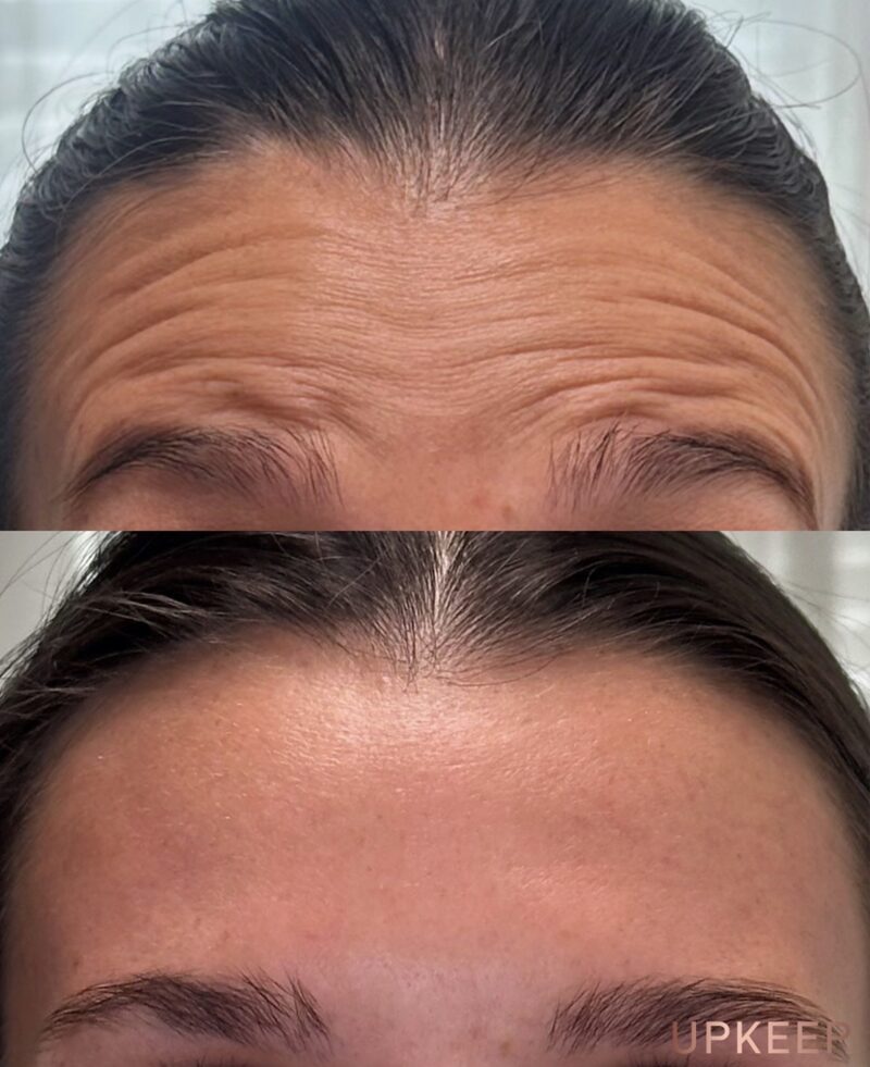 Forehead lines before and after neurotoxin treatment