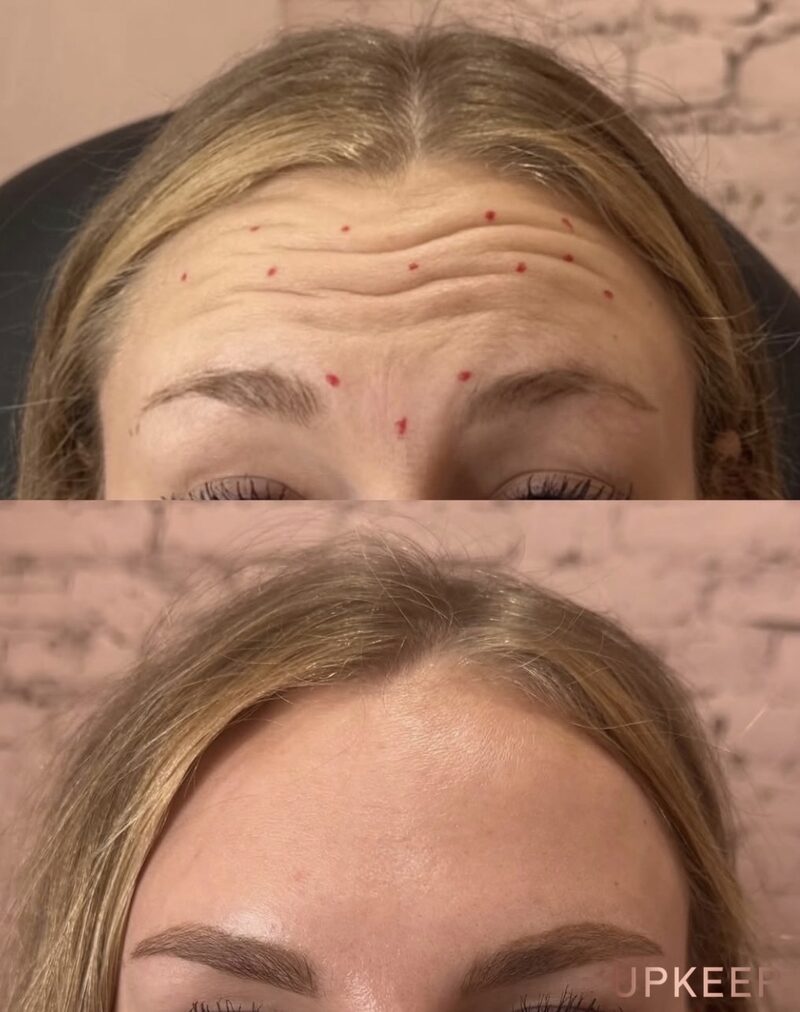 Forehead and frown lines before and after neurotoxin treatment, with injection points marked in the before photo