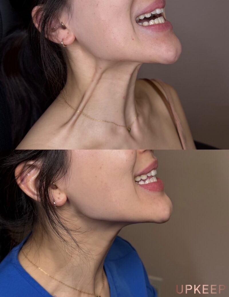 Neck bands and jawline before and after a Nefertiti Lift neurotoxin treatment