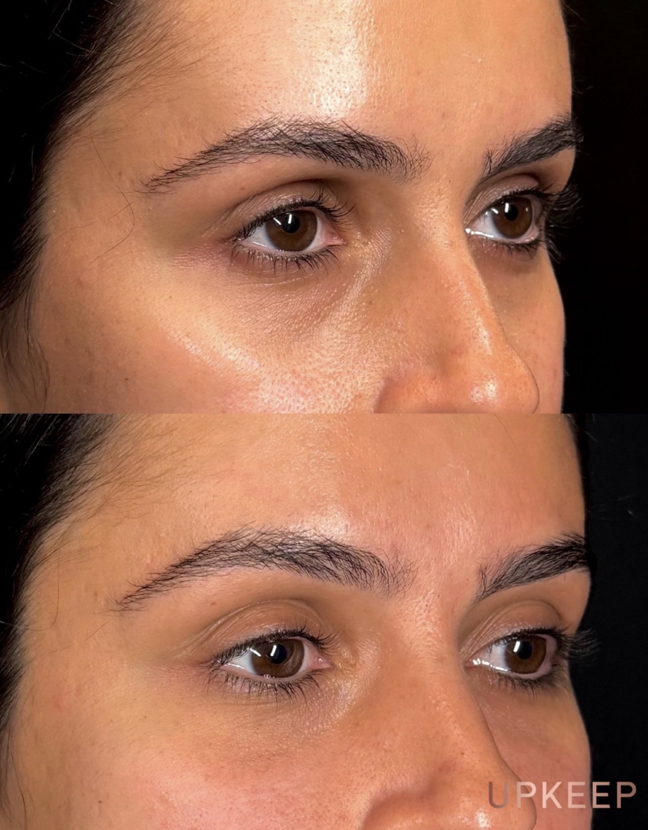 Under eyes before and after tear trough filler, with softer hollows and shadows in the after photo