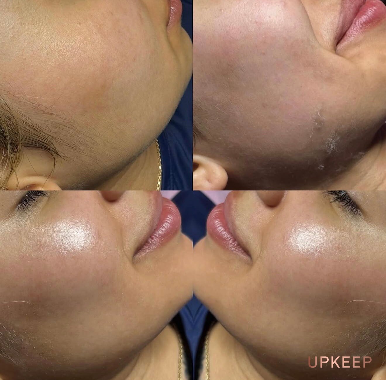 Cheek and jaw skin before and after a Carbon Facial with dermaplaning, looking smoother and brighter
