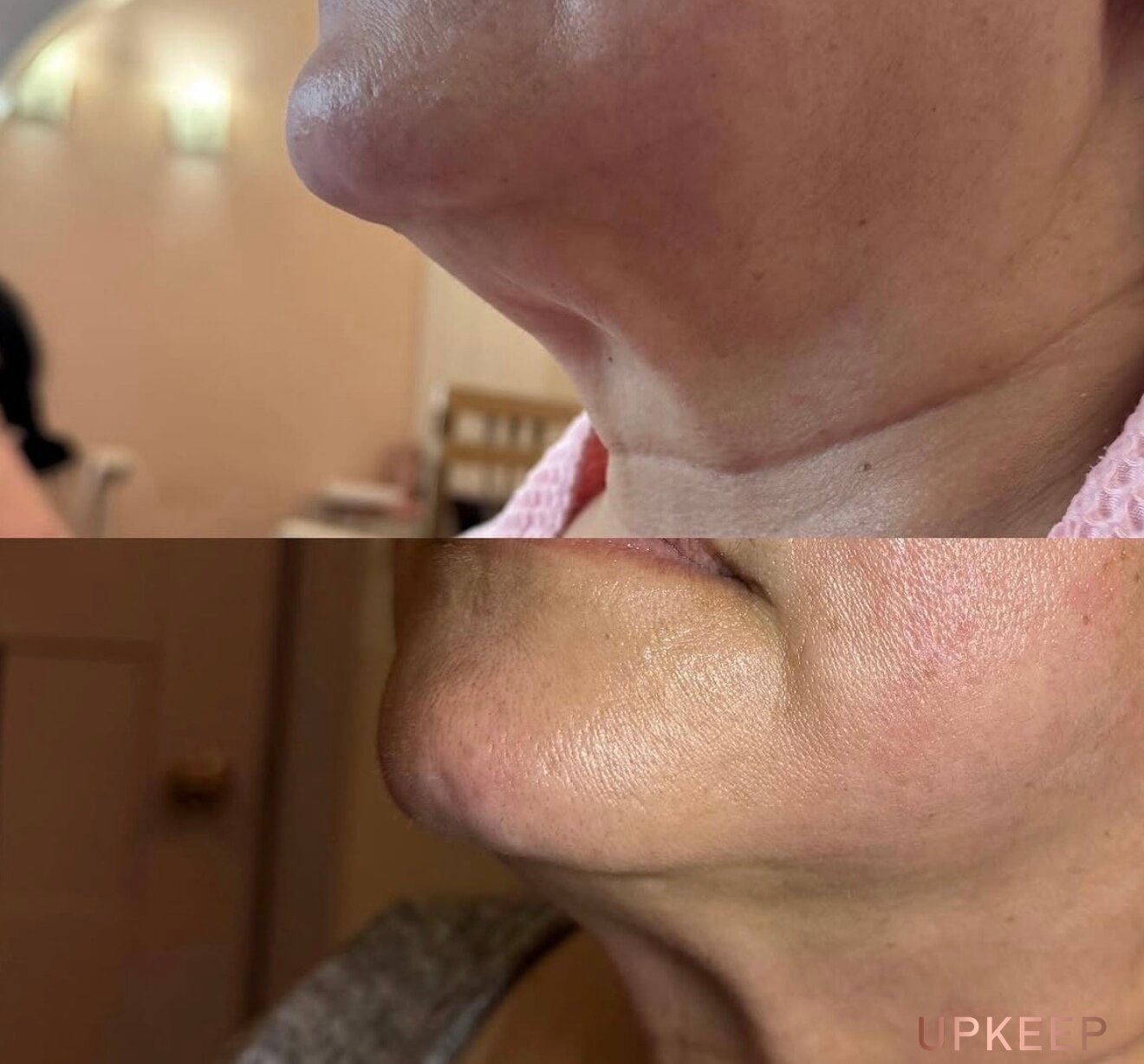 Chin and jawline before and after Venus Freeze and radio frequency microneedling, with tighter, smoother skin