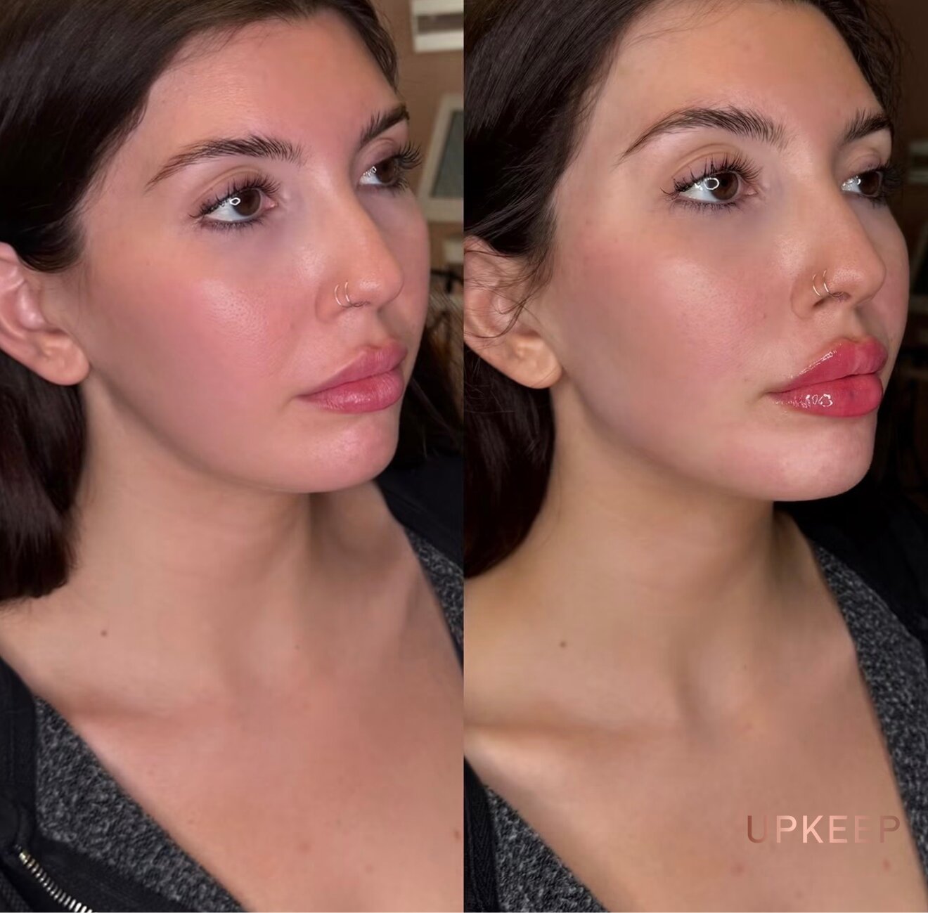 Face before and after Radiesse, with a more defined cheek and jawline contour