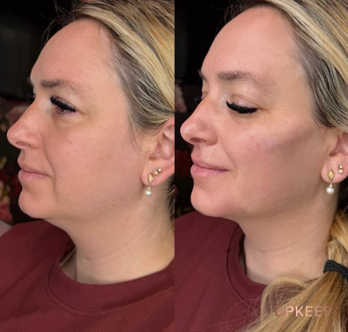 Face before and after Radiesse, with a lifted mid-face and firmer jawline