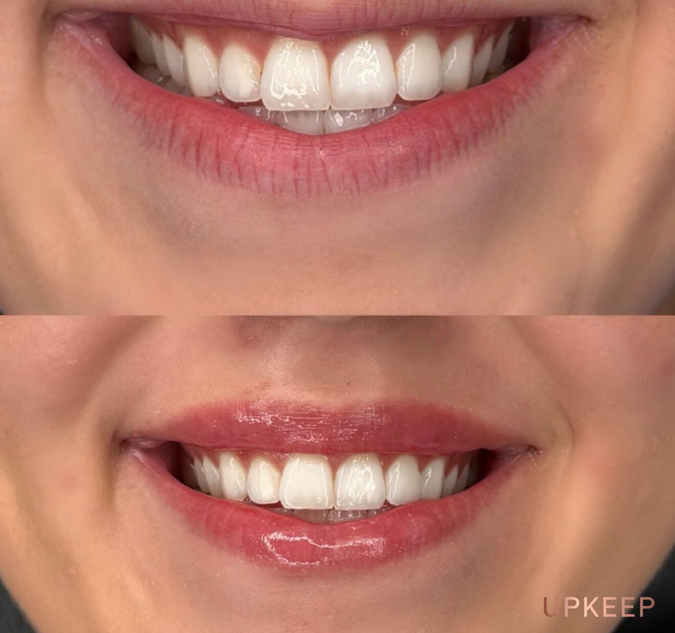 Smile before and after a lip flip, showing less gum and a fuller-looking upper lip
