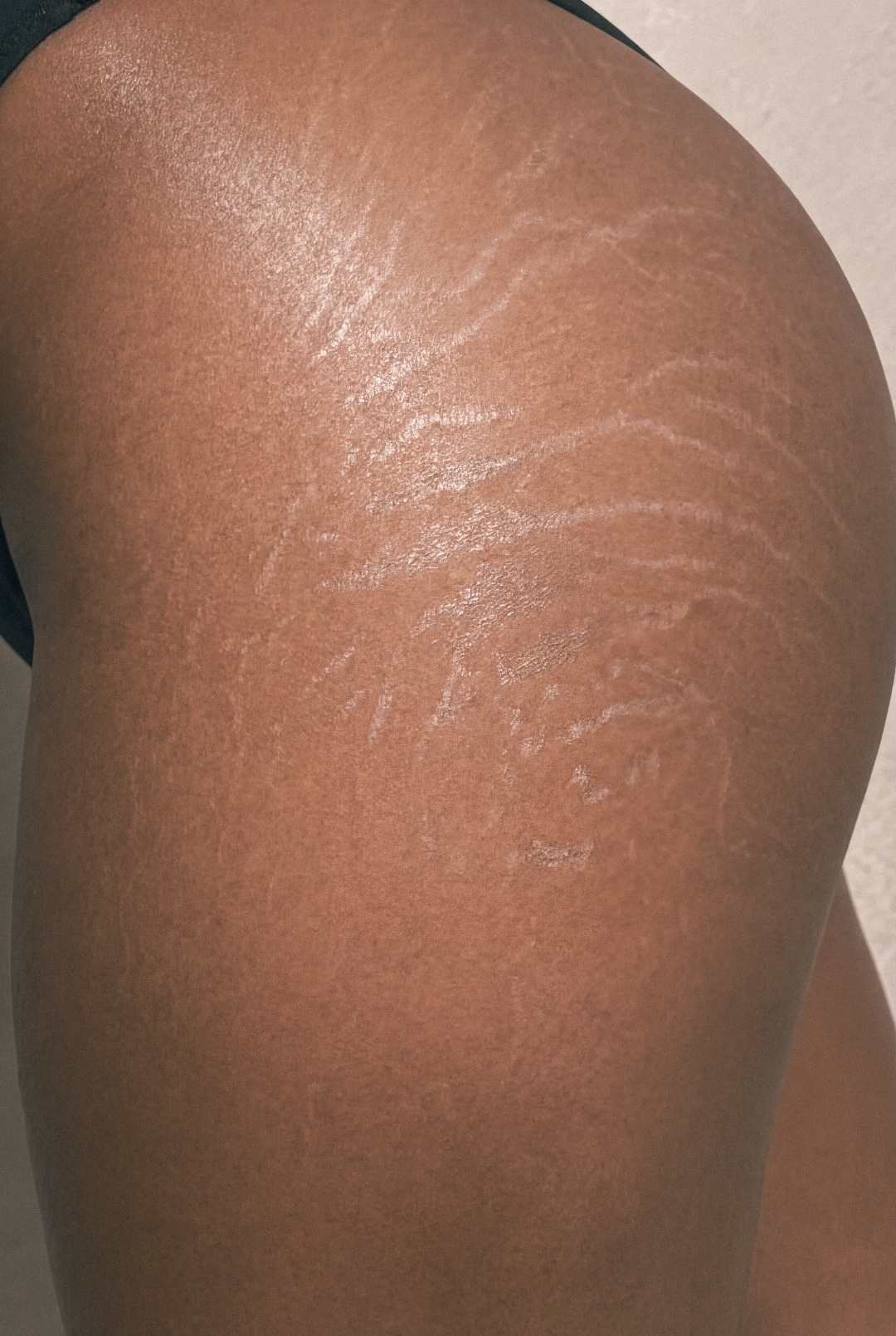 Body contouring treatment